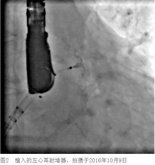 王師傅行經(jīng)皮左心耳封堵術(shù)后6個(gè)月 不服用華法林了